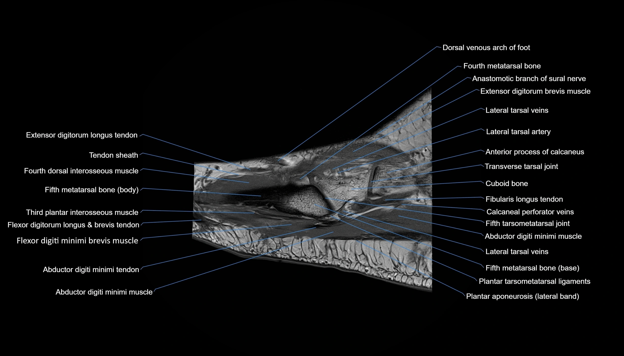 MRI mid foot sagittal cross sectional anatomy 3T  radiology  image-img-00001-00009.webp